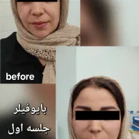 تزریق ژل طبیعی فیلر بوتاکس(کلینیک زیبایی گلد)|خدمات آرایشگری و زیبایی|سنندج, |دیوار