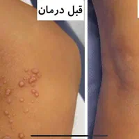 زگیل تناسلی.لیزر زگیل.کرایوتراپی فریز.درمان پوست|خدمات آرایشگری و زیبایی|اهواز, کیانپارس |دیوار
