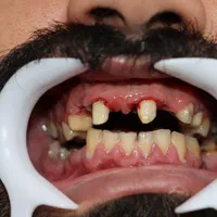 روکش زیرکونیا/ایمپلنت کره ای/ونیر|خدمات آرایشگری و زیبایی|بابل, |دیوار