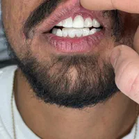 انجام خدمات جرمگیری دندان و ترمیم دندان های پوسیده