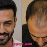 یک بار کاشت و سال‌ها لذت از موهای خودت