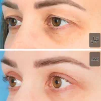 تخفیف جراحی پاک(بلفاروپلاستی)