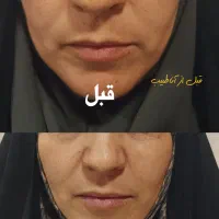 ضدچروک و ضدلک بدون بازگشت