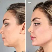 مدل تزریق فیلر فقط هزینه مواد دریافت میشود