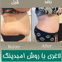 لاغری و لیفت با روش جدید امبدینگ|پزشکی|تهران, نیلوفر|دیوار