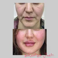 لب روسی پروفیس .جوانسازی.  پزشک|خدمات آرایشگری و زیبایی|اهواز, زیتون کارمندی|دیوار