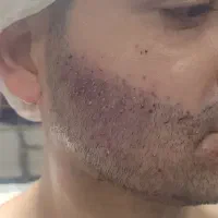 کاشت مو.ابرو.ریش