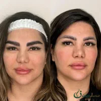 کاشت ابرو در بوکان با روش میکروکاشت و FUT