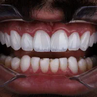 ارتودنسی ایمپلنت دیجیتال لمینت کامپوزیت