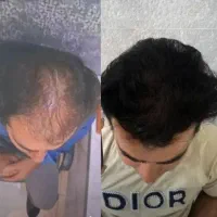 کاشت مو|خدمات آرایشگری و زیبایی|کرمانشاه, |دیوار