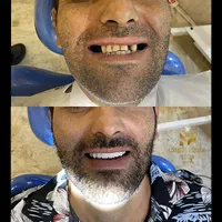 دندانسازی رویال (مرادلو)|خدمات آرایشگری و زیبایی|تهران, قنات‌کوثر|دیوار