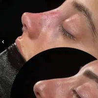 عمل بینی توسط متخصص