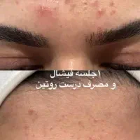 پاکسازی فیشال و آبرسانی درمان لک و جوش|خدمات آرایشگری و زیبایی|زابل, |دیوار