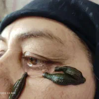 حجامت ،فصد ،زالو تراپی