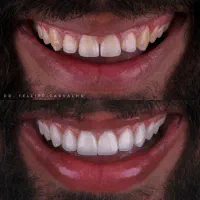 وام دندانپزشکی عصبکشی ایمپلنت .کامپوزیت