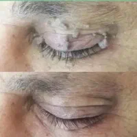 زگیل و تبخال