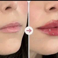 فیلرمزو ژل بوتاکس prp آنزیم جوانسازیprf اگزوزوم