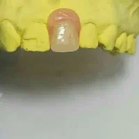 دندانسازی ساخت دندان مصنوعی متحرک باضمانت|آرایشی، بهداشتی، درمانی|مشکیندشت, |دیوار