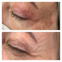 برداشتن گوشت اضافه صورت وبدن|خدمات آرایشگری و زیبایی|اصفهان, کوجان|دیوار