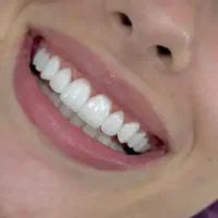 کامپوزیت دندان/دندانپزشکی/اقساط