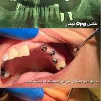 ایمپلنت اقساط با ضمانتنامه مادام العمر|خدمات آرایشگری و زیبایی|تهران, قیطریه|دیوار