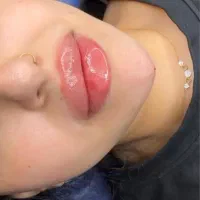 خدمات فیلر و بوتاکس در کلینیک