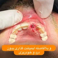 ایمپلنت دیجیتال دندان از دم اقساط اوردنچر کاشت|خدمات آرایشگری و زیبایی|تهران, قیطریه|دیوار