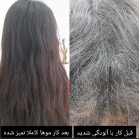 درمان شپش سر ۱۰۰٪ تضمینی و تخصصی