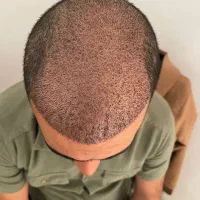 کاست مو و ابرو میکروگرفت