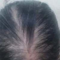 یک خداحافظی ابدی با ریزش مو برای همیشه