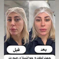 تزریق ژل بوتاکس لیفت نخ هایفو بلفاروپلاستی لیزر|خدمات آرایشگری و زیبایی|مشهد, کوه سنگی|دیوار