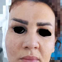 لیفت صورت وپیشانی و شقیقه