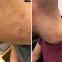 خالبرداری لیپوم منگوله تگ زگیل میخچه توسط پزشک|خدمات آرایشگری و زیبایی|تهران, شهرک غرب|دیوار
