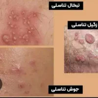 بهبود زگیل تناسلی