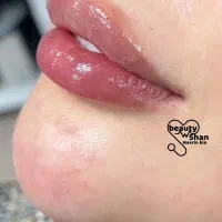 خدمات زیبایی ساکشن و تزریق فیلر های بادی|خدمات آرایشگری و زیبایی|خرمآباد, |دیوار