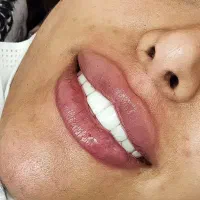 خدمات ژل و بوتاکس