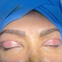 بلفاروپلاستی (جراحی زیبایی پلک ) اقساطی