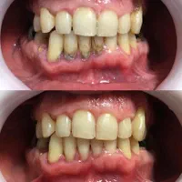 انجام خدمات جرمگیری دندان و ترمیم دندان های پوسیده|خدمات آرایشگری و زیبایی|آبادان, |دیوار