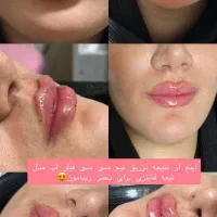 مطب زیبایی لیزر بوتاکس ژل مزو نخ لک جوش