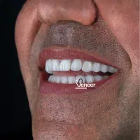 کامپوزیت دندان لمینت جرم گیری لیفت لثه منطقه ۱