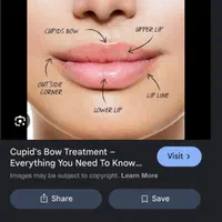 تزریق ژل بوتاکس و لیفت صورت با نخ و مزوژل