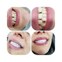 کامپوزیت فقط فکی ۱۶ تومن وآموزش  روز کامپوزیت|خدمات آرایشگری و زیبایی|تهران, شمشیری|دیوار