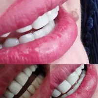 کامپوزیت ،پرکردن دندان ،ترمیم دندانهای پوسیده