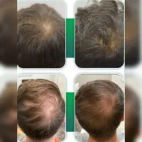 درمان تخصصی ریزش مو با PRP (تخفیف ویژه) پی ار پی