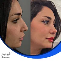 جراحی عمل بینی با تخفیف