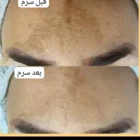 درمان تخصصی لک بدون لیزر|آرایشی، بهداشتی، درمانی|بوشهر, |دیوار