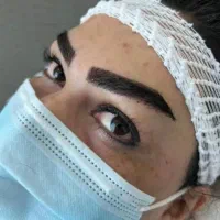 کاشت ابرو تضمینی /کاشت مو طبیعی