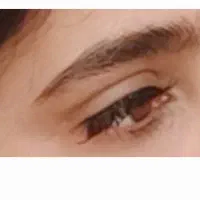 کاشت مژه هیدن(فیشر)