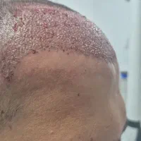 کاشت مو