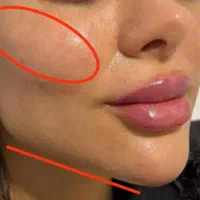 ژل و بوتاکس مزوتراپی و مزونیدلینگ آرایش دایم|خدمات آرایشگری و زیبایی|اردکان, |دیوار